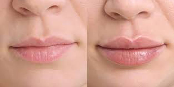 Lips Treatment Before and After Photos | Nuvo Aesthetics Clinic in Sycamore, IL