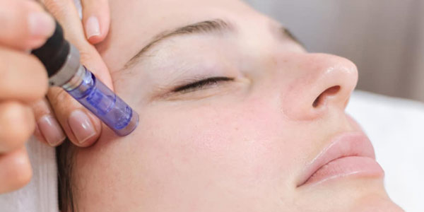 Young Female Receiving Microneedling Treatment in Sycamore, IL | Nuvo Aesthetics Clinic