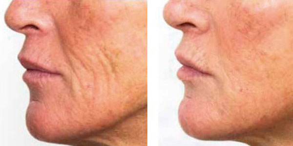 No Peel Facial Treatment Before and After Photos | Nuvo Aesthetics Clinic in Sycamore, IL