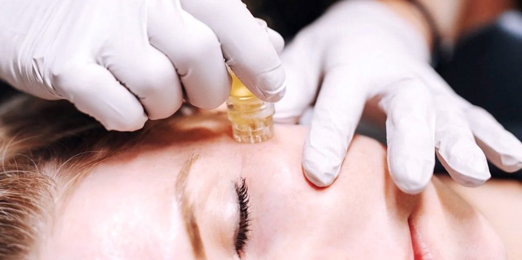 Young Woman Receiving Microgold Infusion Treatment in Sycamore, IL | Nuvo Aesthetics Clinic
