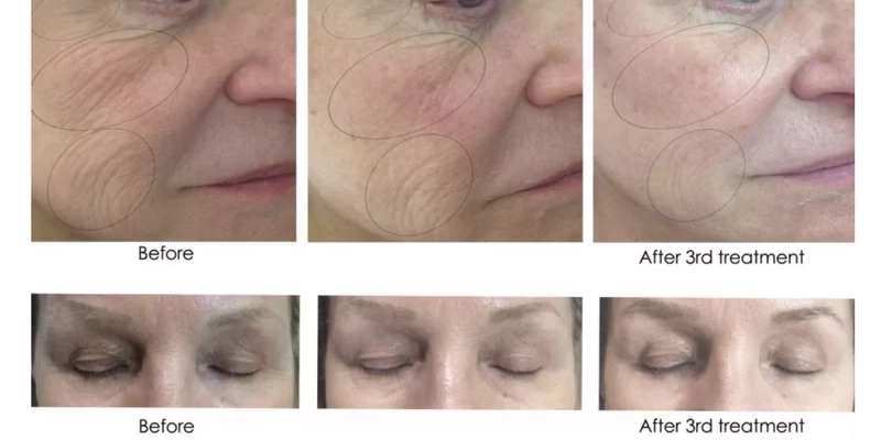 CO2 Lift Pro Carboxy Face Mask​ Before and After Images in Sycamore, IL | Nuvo Aesthetics Clinic